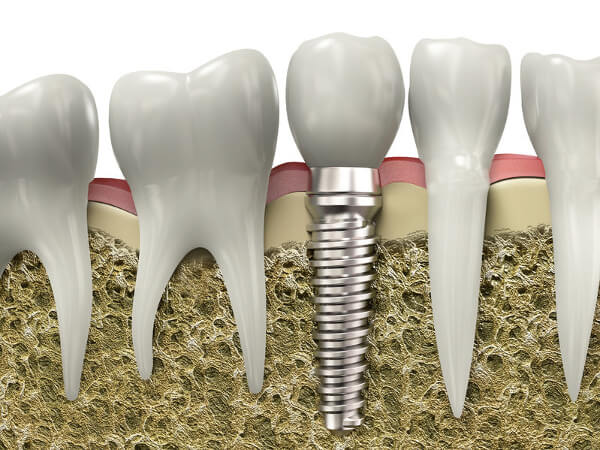 dental implantátum